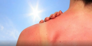 ¿Cómo tratar la piel quemada por el sol?