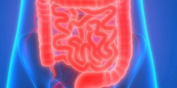 El 80 % de pacientes con enfermedad celíaca no sabe que la padece