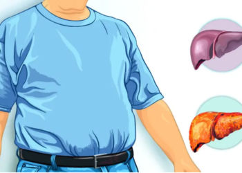 Hígado graso no alcohólico es una pandemia