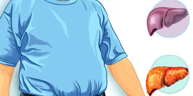 Hígado graso no alcohólico es una pandemia