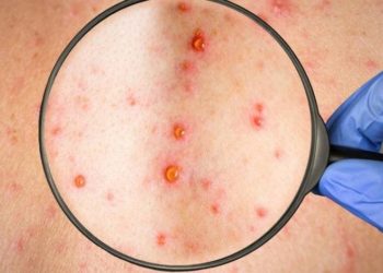 Salud Pública notifica primer caso sospechoso de viruela símica en República Dominicana